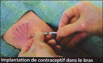 Download free software Patch Contraceptif Prix 2011 Download free software Patch Contraceptif Prix 2011