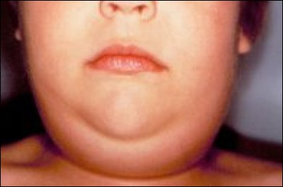 Quelle est la maladie contagieuse qui touche essentiellement les enfants de 6 à 12 ans, se caractérise par un visage en forme de poire, et peut entraîner des complications graves lorsqu'elle est contractée à l'âge adulte ?