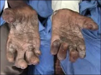 La lèpre est une maladie. Vrai ou faux ?