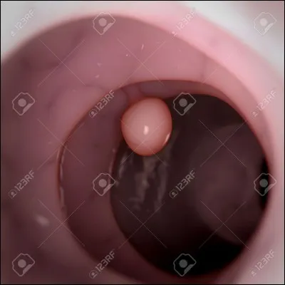 Laquelle des propositions suivantes se rapproche le plus de la définition du mot "polype" ?