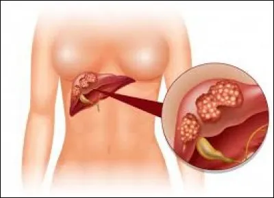 Il a mal à son ____.