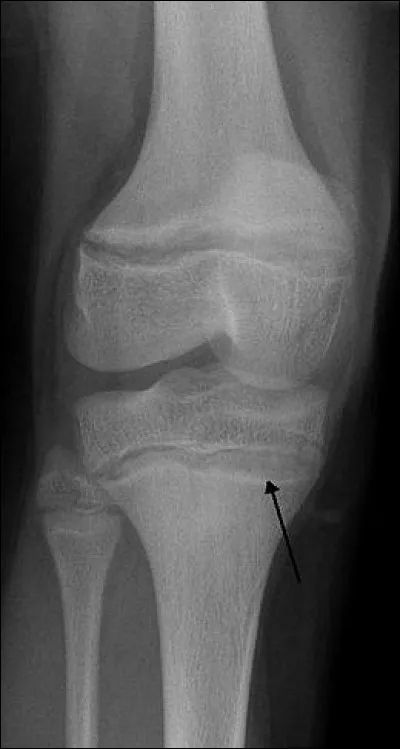 Trouvez le nom de cette maladie correspondant à une intoxication aiguë ou chronique par le plomb.