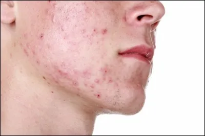 Trouvez le nom de cette affection :