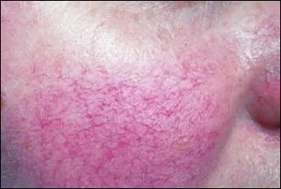 Trouvez le nom de cette affection :