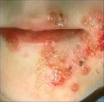 Trouvez le nom de cette affection :