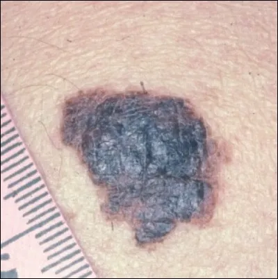 Trouvez le nom de cette affection :