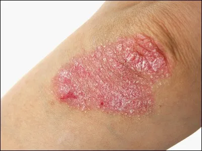 Trouvez le nom de cette affection :