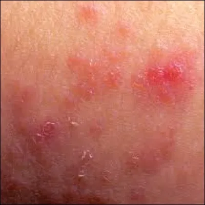 Trouvez le nom de cette affection :