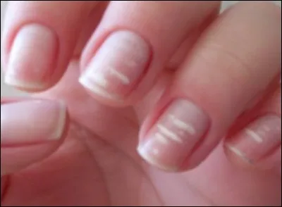 Trouvez le nom de cette affection :