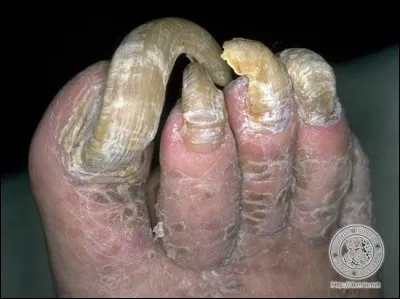 Trouvez le nom de cette affection :