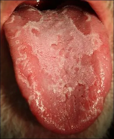 Comment appelle-t-on cette maladie de la langue, caractérisée par des lésions blanchâtres ?