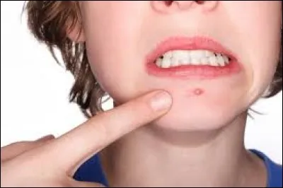 Complétez : __ acné.