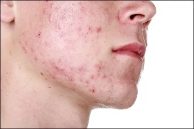 Cela peut servir chez le dermatologue. Quel est le genre du mot "acné" ?