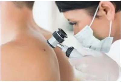 Quel cancer de la peau peut prendre l'apparence d'un grain de beauté ?