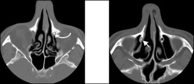 Que contiennent les sacs lacrymaux ?