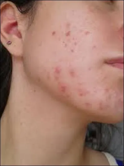 Je n'aime pas les __ d'acné.