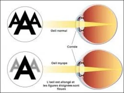 La myopie correspond-elle à la presbytie ?