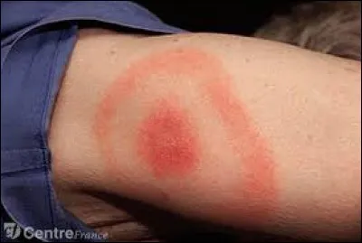 Par quelle bestiole est causée la maladie de Lyme ?