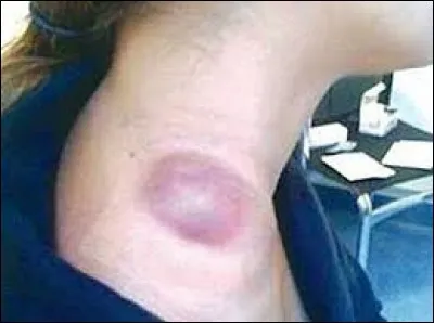 Quel organe est principalement touché par la tuberculose ?