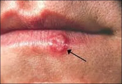 Quel virus sexuellement transmissible se manifeste de telle sorte qu'on le surnomme "bouton de fièvre" ?