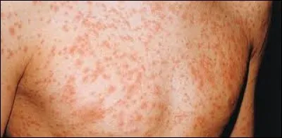 Quelle est cette maladie que les enfants Brown gardés par Nanny McPhee feront-ils semblant d'avoir ?