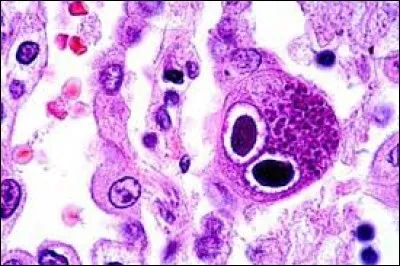 Cochez ce qui est vrai sur le cytomégalovirus.