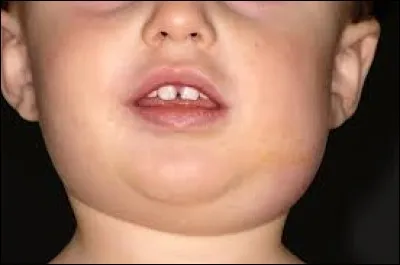 Comment les oreillons se transmettent-ils ?