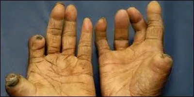 Laquelle de ces maladies le bacille de Hansen provoque-t-il ?