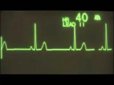 Quelle est la définition de "bradycardie" ?