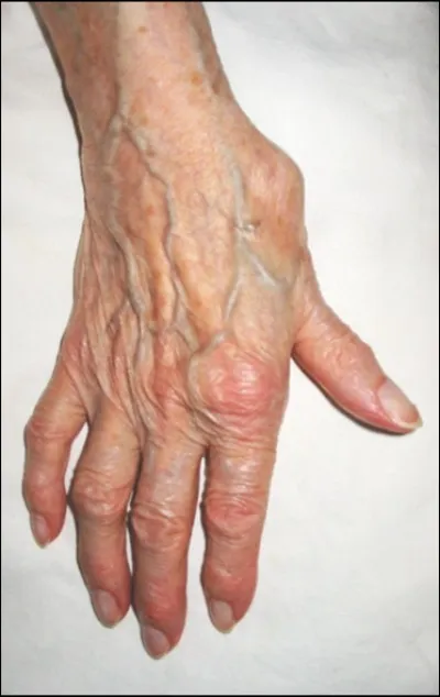 La rhizarthrose est l'arthrose de la base du pouce.