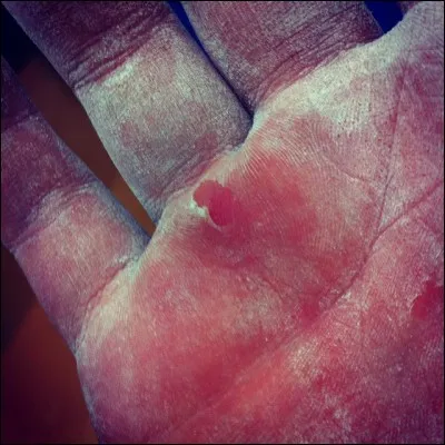 Comment se fait-on cette blessure ?