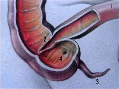 L'appendicite peut survenir à tout âge mais surtout avant 30 ans.