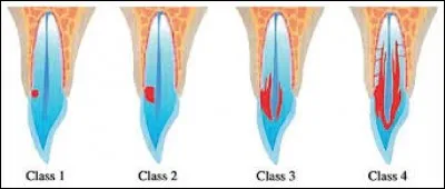 Disparition progressive d'un épanchement pathologique, d'une tumeur, d'un corps étranger, d'un organe :