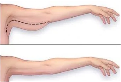 Le bras ne comporte qu'un seul os, l'humérus.