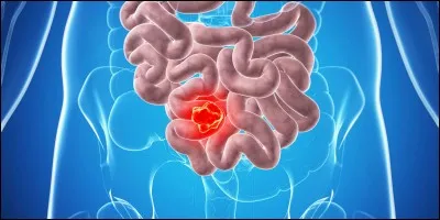 Le Cancer - La France fait partie des pays où l'incidence du cancer du sein est très élevée sur un plan mondial.