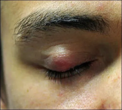 O&ugrave; trouve-t-on le chalazion ?