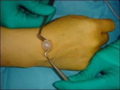 Laquelle de ces choses peut-on trouver dans un kyste ?