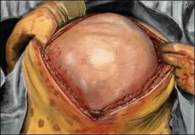 O&ugrave; trouve-t-on les kystes biliaires simples ?