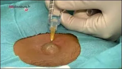 Lequel de ces sexes peut avoir des kystes ?