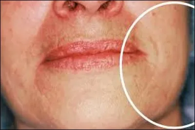 O&ugrave; ne peut-on pas avoir des kystes en cas de polykystose r&eacute;nale h&eacute;r&eacute;ditaire ?