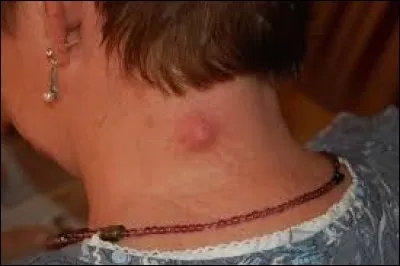 Quelle est la taille minimale des kystes ?