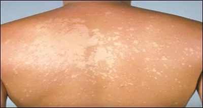 Vous avez une dermatose caractérisée par une fine desquamation. Quelle pathologie avez-vous ?