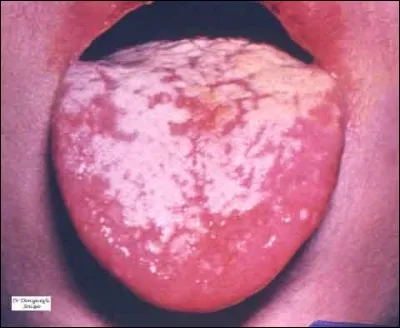 Certaines maladies infectieuses peuvent être à l'origine d'un champignon, (mycose) sur la langue. On lui donne le nom charmant de...