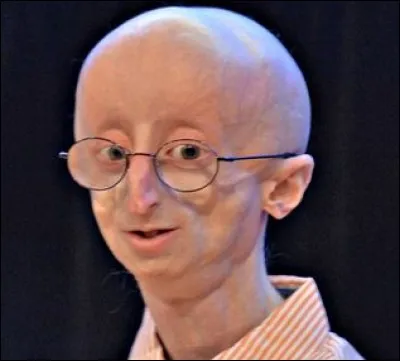 La "progeria" est une maladie aussi exceptionnelle que médiatique. Comment se traduit-elle ?