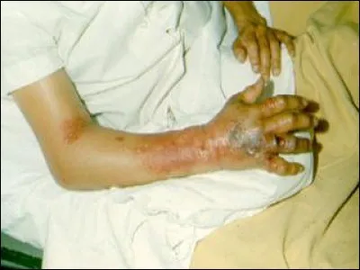 Qu'est-ce qu'un "anthrax" ?