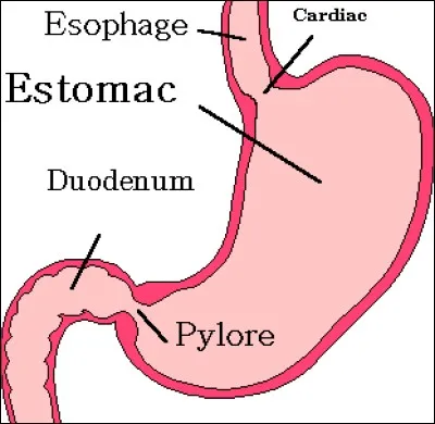 Comment s'appelle le rétrécissement au niveau du sphincter du pylore qui provoque une gêne à l'évacuation gastrique et plus ?