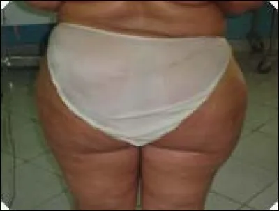 Autrefois, on inventa, pour protéger du froid, les cuisses de ces dames qui faisaient du cheval à califourchon, des pantalons bouffants qui laissèrent leur nom à un amas de graisse disgracieux sur le haut des cuisses desdites dames. C'était ... .