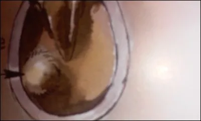 Quelle est la blessure de la sole ?