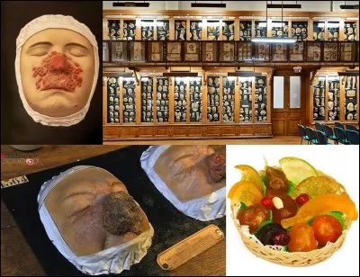 Retournons vers « l'hôpital Saint-Louis » !
Créé en 1607, cet hôpital était utilisé pendant les différentes épidémies que Paris subissait. Mais, en 1801, il est affecté au traitement des maladies dermatologiques (il l'est encore, actuellement). Une collection d'organes en cire a été créée pour montrer ces maladies. Certains moulages des parties malades ont été créés par Jules Baretta.
Quel était son métier avant de réaliser ces moulages.