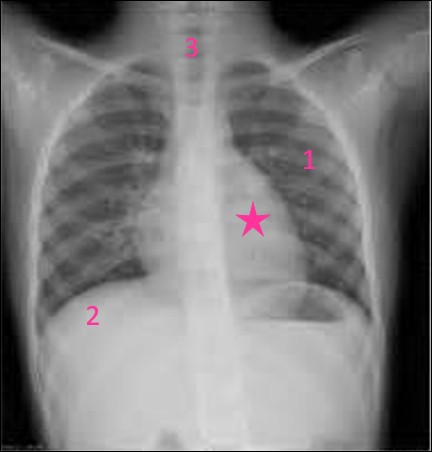 Nous voici dans une région vitale : le thorax. Vu ici via une radiographie de face. Quel organe, indispensable à la vie, est marqué d'une étoile rose ?